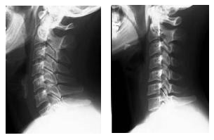 頸椎X線画像